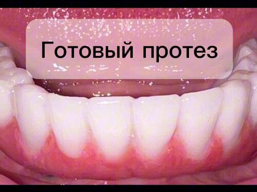 Стом НБ