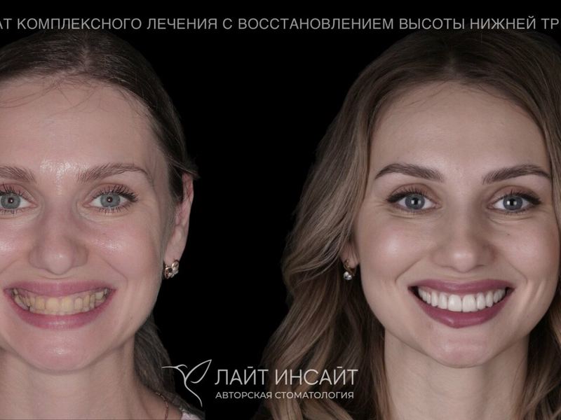 Лайт Инсайт
