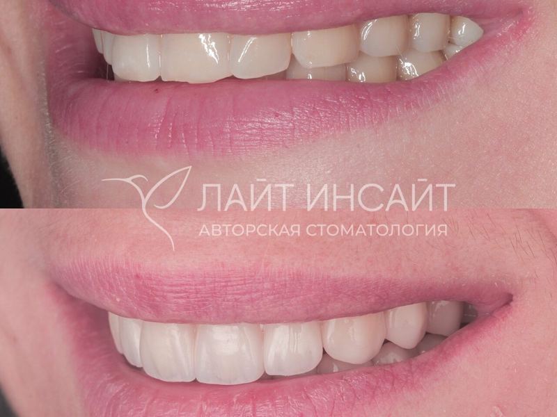 Лайт Инсайт